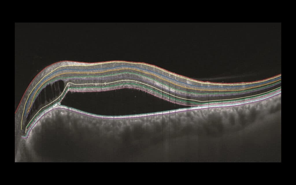 AI Retina segmentation